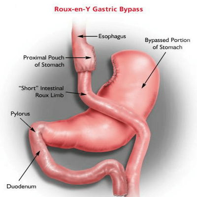 Gastric Bypass Surgery in Islamabad Pakistan