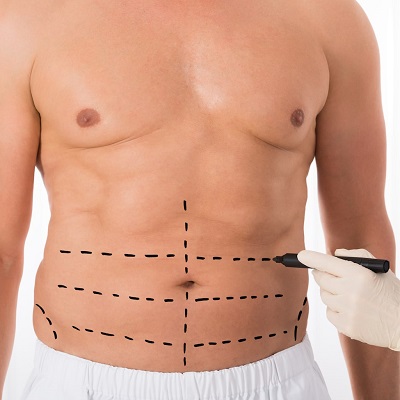 How liposuction improves your physique