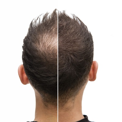How many sessions of exosomes for hair loss