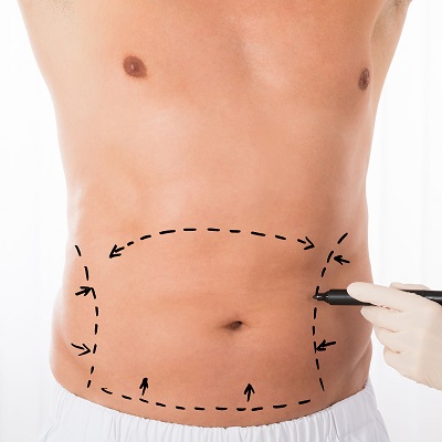 What is the best alternative to liposuction