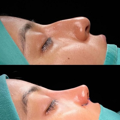 How Long Does Rhinoplasty Take to Heal?