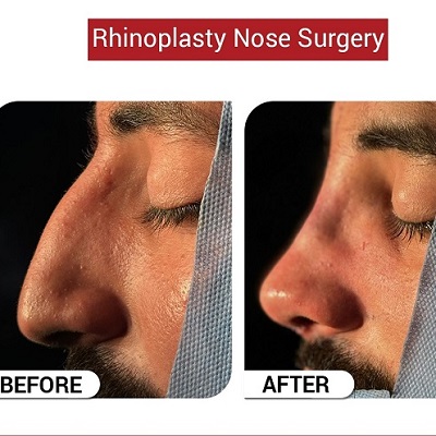 rhinoplasty nose reshaping in Islamabad