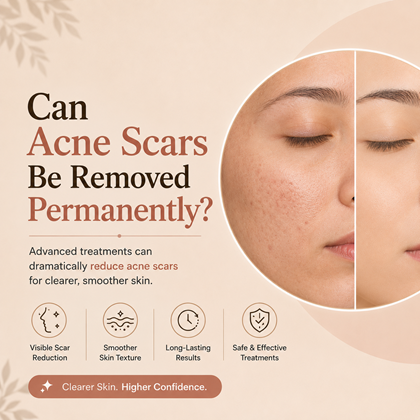 Can Acne Scars Be Removed Permanently?