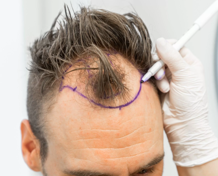 hair transplant Rawalpindi